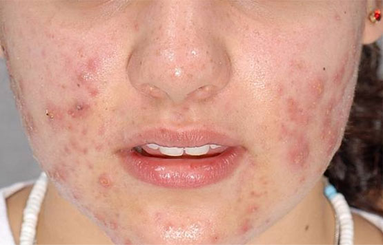 Acne Scars before Chemical Peels treatment